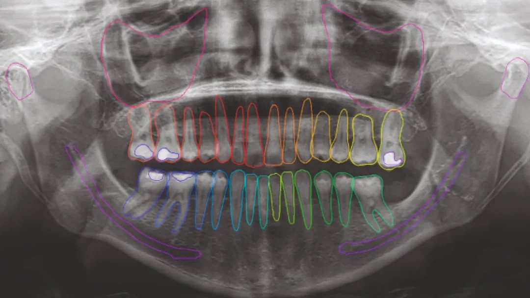 Annotated panoramic CBCT scan output