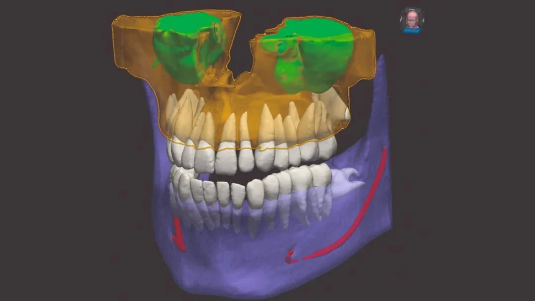 3D CBCT reconstruction